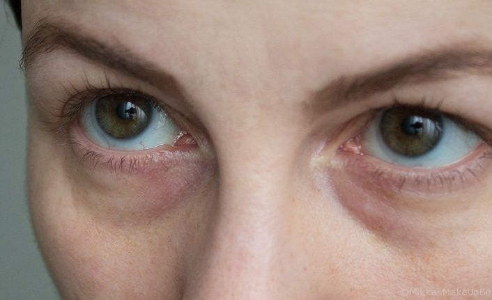 Göz altı morlukları neden oluşur ve nasıl giderilir?