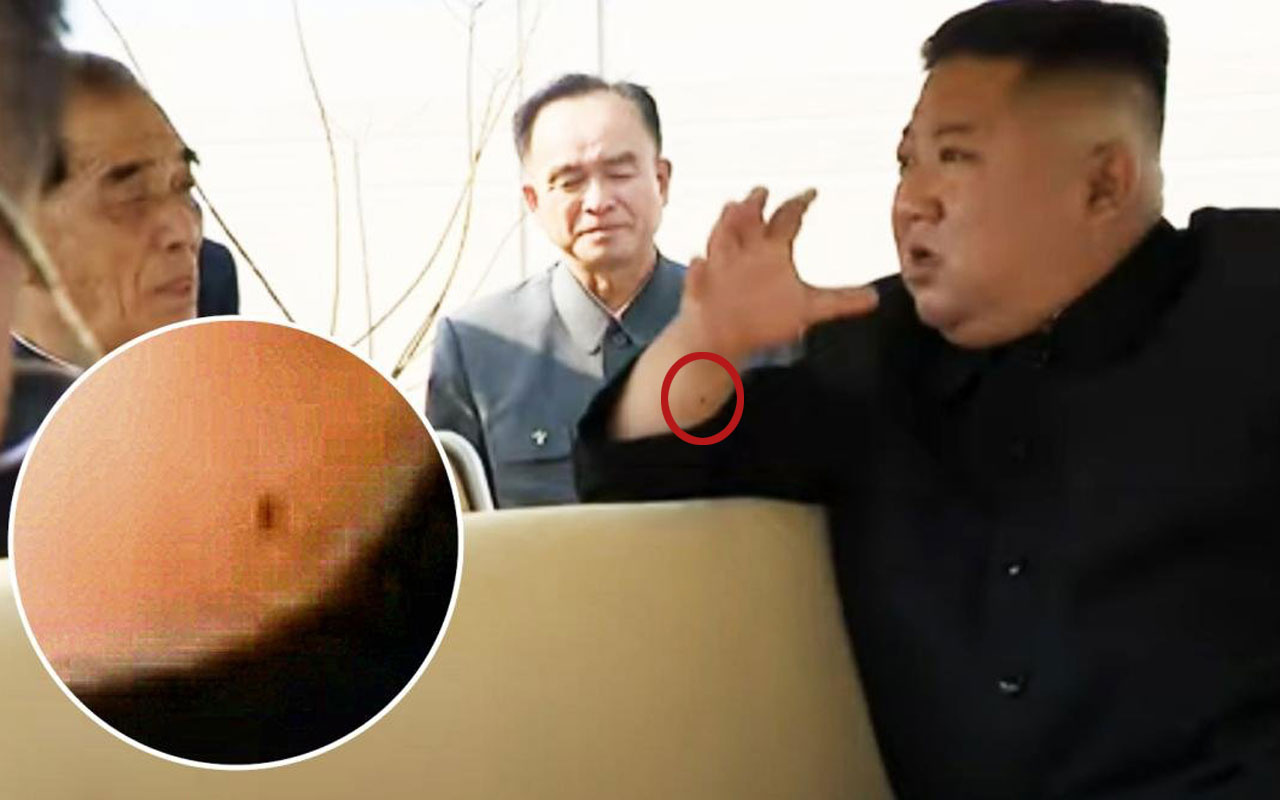 Kuzey Kore lideri Kim Joung-un'un kolundaki izler ne? Yakın dostu herşeyi açıkladı