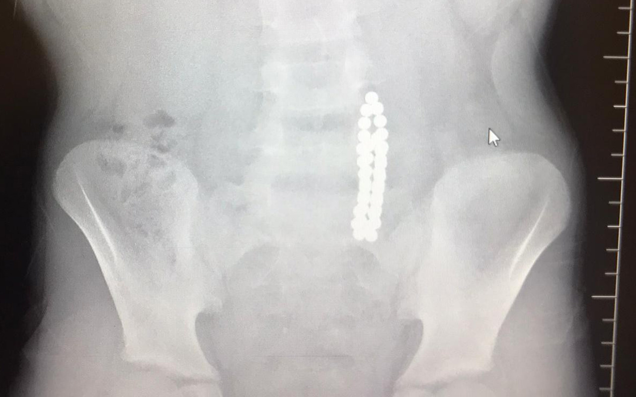Karın ağrısıyla hastaneye giden çocuğun midesinden 42 adet mıknatıs topu çıktı
