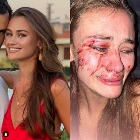 Çeşme'de dövülen model Daria Kyryliuk'un ifadesi ortaya çıktı! Detaylar korkunç