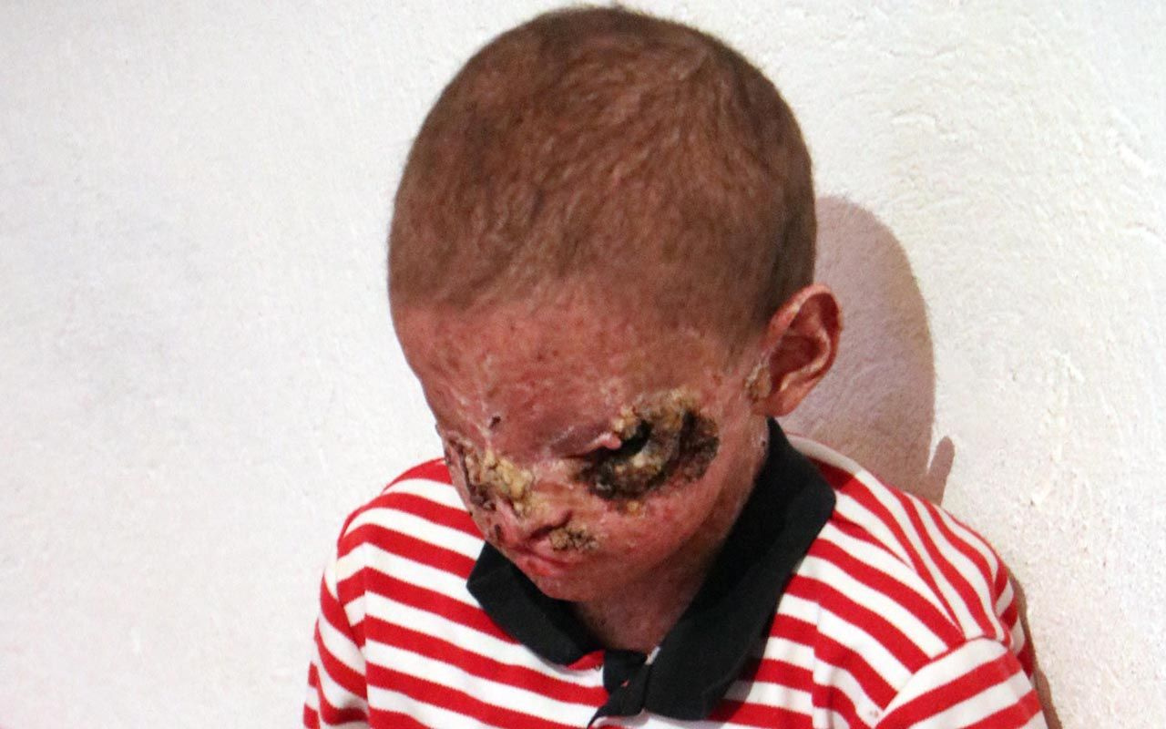 Erzurum'da cilt kanseri 8 yaşındaki Salih yardım bekliyor