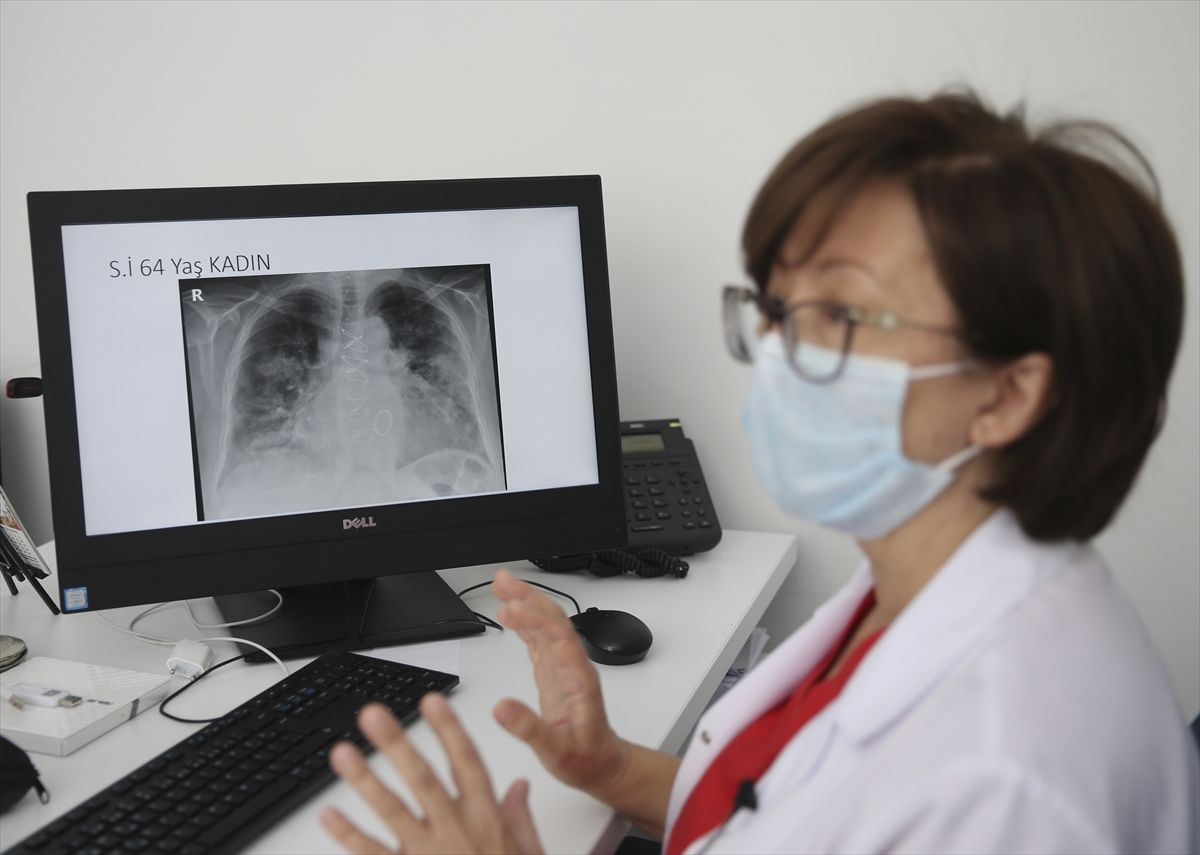 Koronavirüsün akciğerdeki ağır tahribatı hastaların tomografi görüntülerine yansıdı