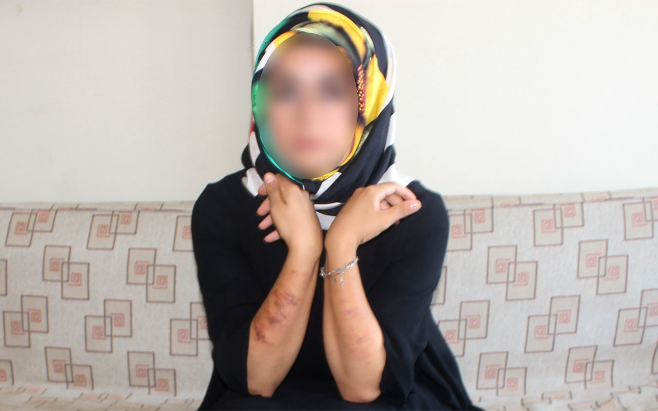 Lazer epilasyon yaptıran kadın yandı! Adıyaman'da güzellik kazası