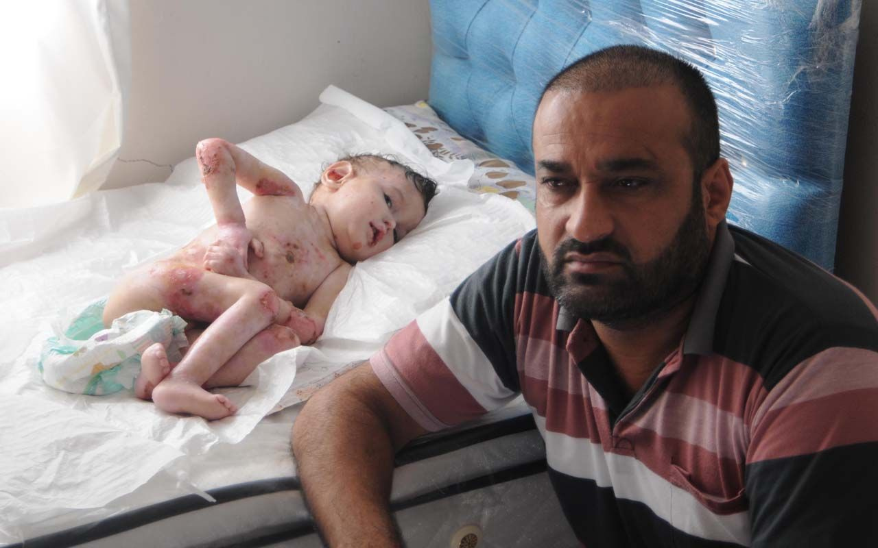 Görenin yüreği burkuluyor Şanlıurfa'da kelebek hastası Abdullatif için ailesi yardım istiyor