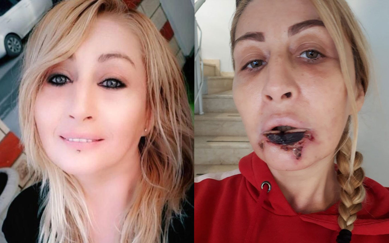 Antalya'da estetik faciası kadının dudağı çürüyerek düştü!