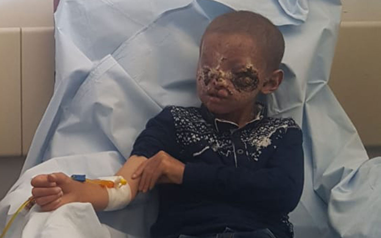 Erzurumlu 8 yaşındaki Salih güneşe çıkabilecek! Cilt kanseri yüzünü bu hale getirmişti