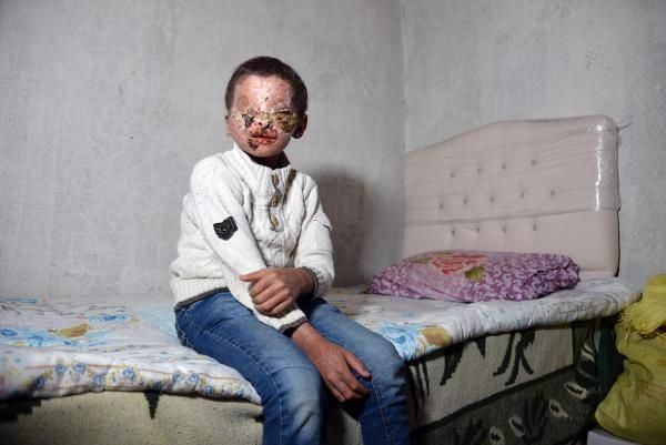 Erzurumlu 8 yaşındaki Salih güneşe çıkabilecek! Cilt kanseri yüzünü bu hale getirmişti