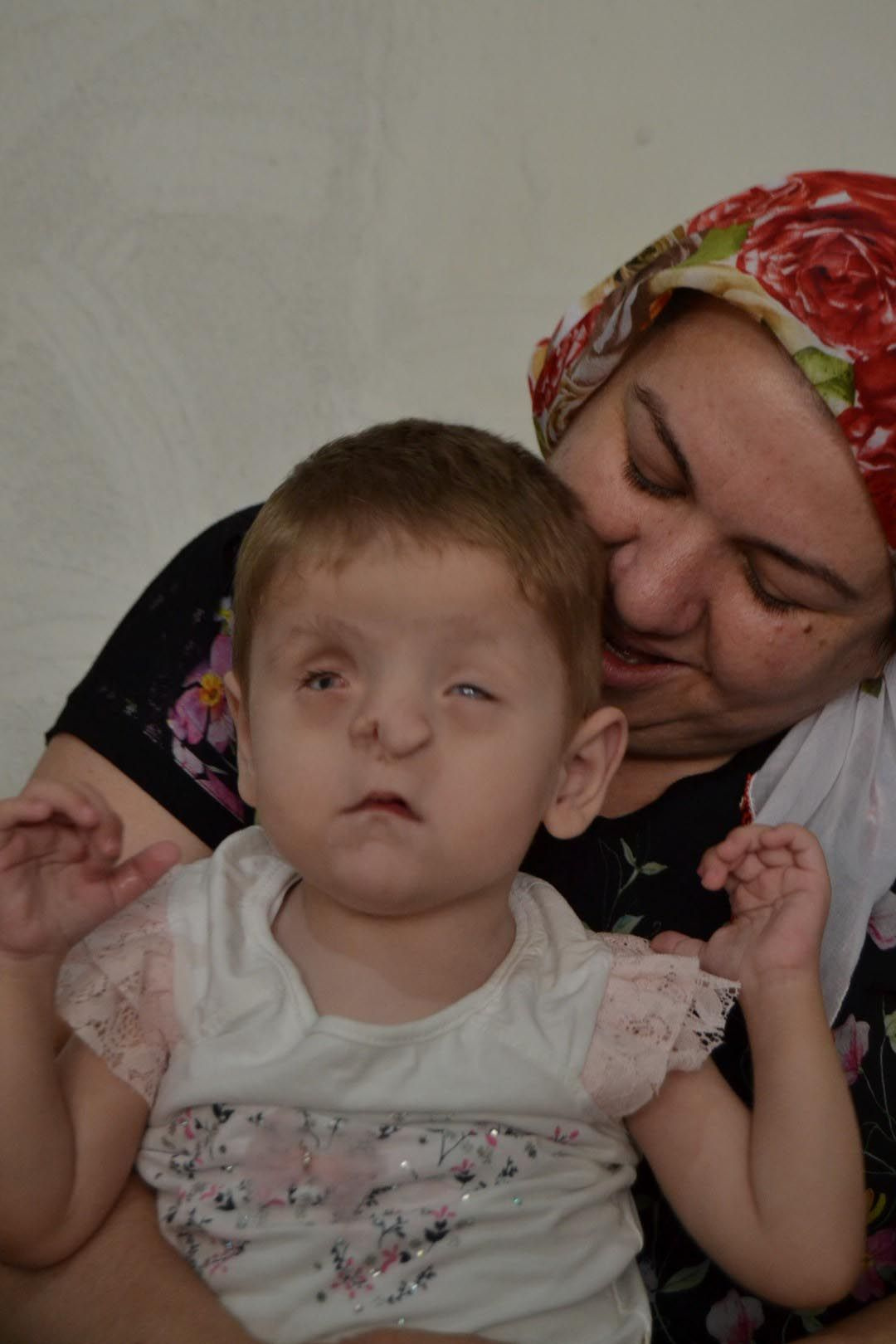 Burun delikleri yok sırtında tümör var Manisa'da Sevgi Hira annesini temasla tanıyor
