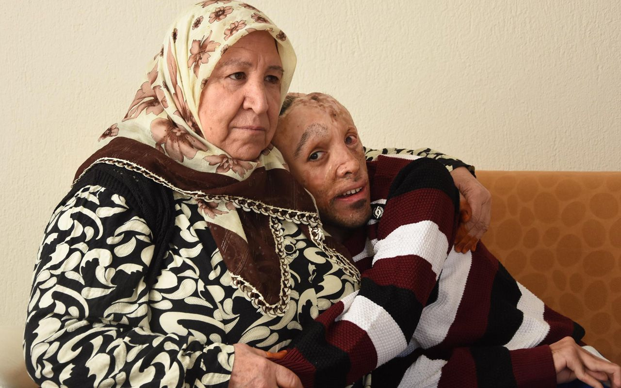 İzmir'de 6 aylık bebekken yandı belinden ve bacağından alınan dokular başına nakledildi