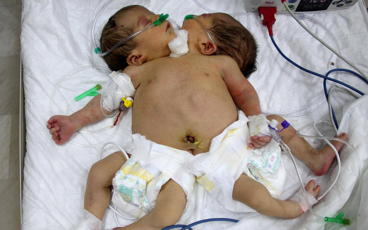 Siyam ikizleri Hatay'da tedavi altına alındı tek kalple yaşama tutunuyorlar!