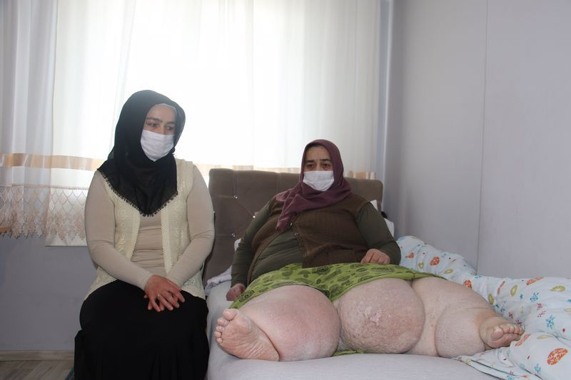Ankara'da kılcal damarları koptu hayatı kabusa döndü! Her yıl daha çok şişiyor