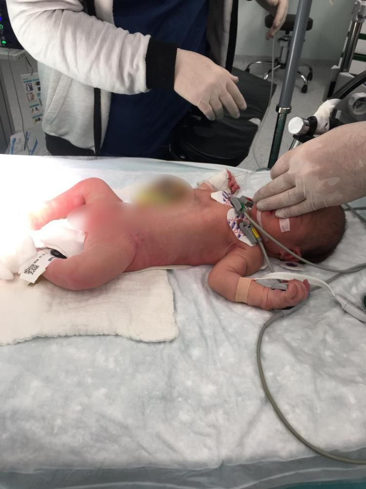 Milyonda bir görülüyordu! Mersin'de 1 günlük Miray bebek iç organları dışarıda doğdu