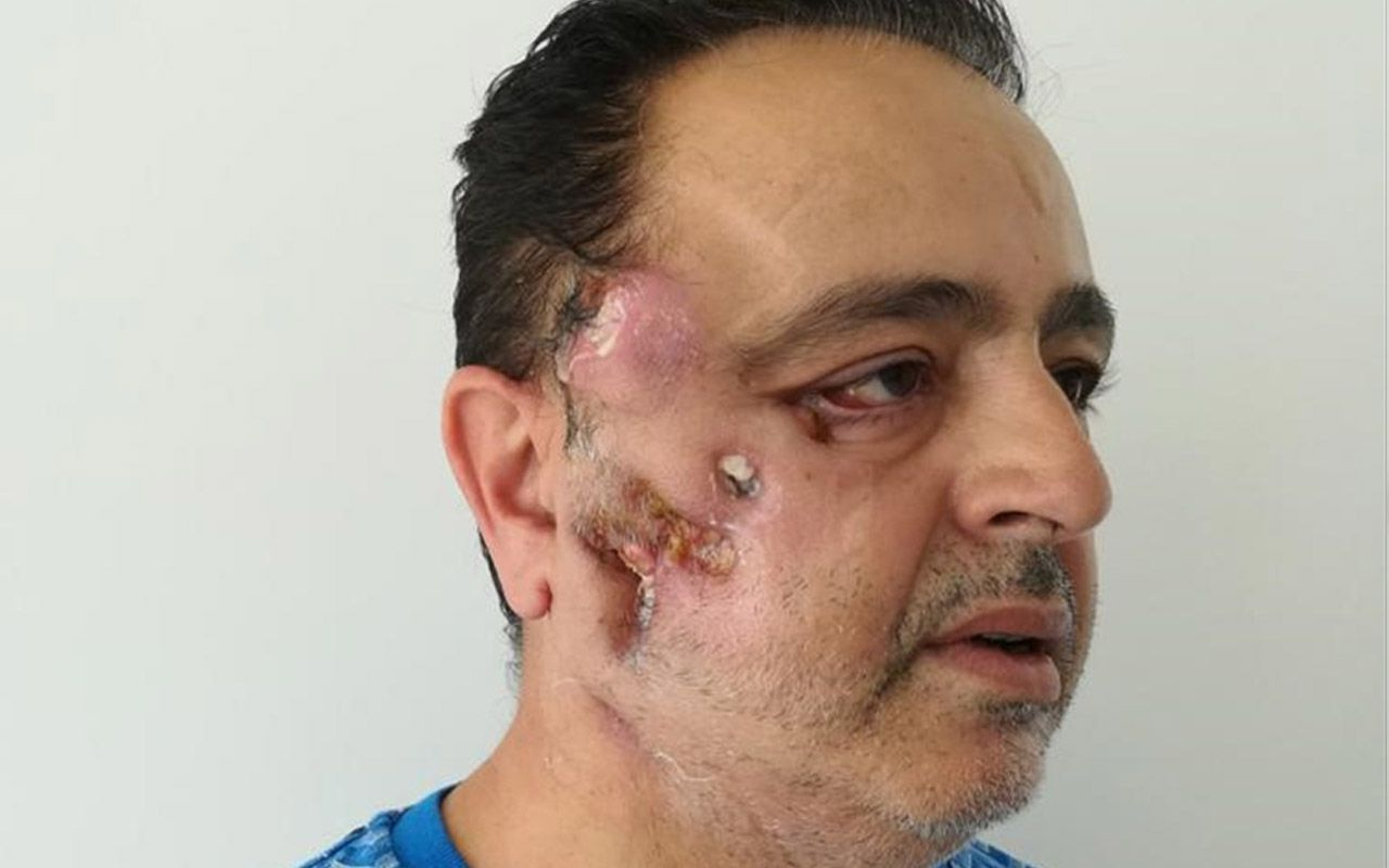 Antalya'da kanserden yüzünü kaybetti! Yapay kemik ve omzundan doku alınıp yüz yapıldı