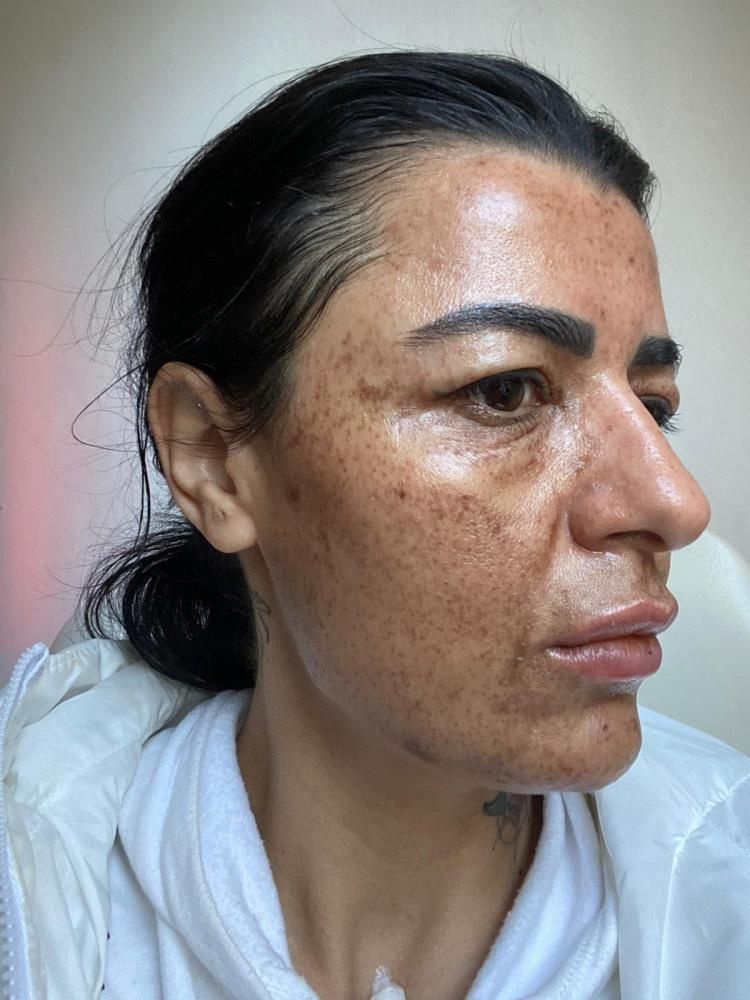 Antalya'da güzellik salonu ilanı hayatının şokunu yaşattı! Yüzünü yaktılar