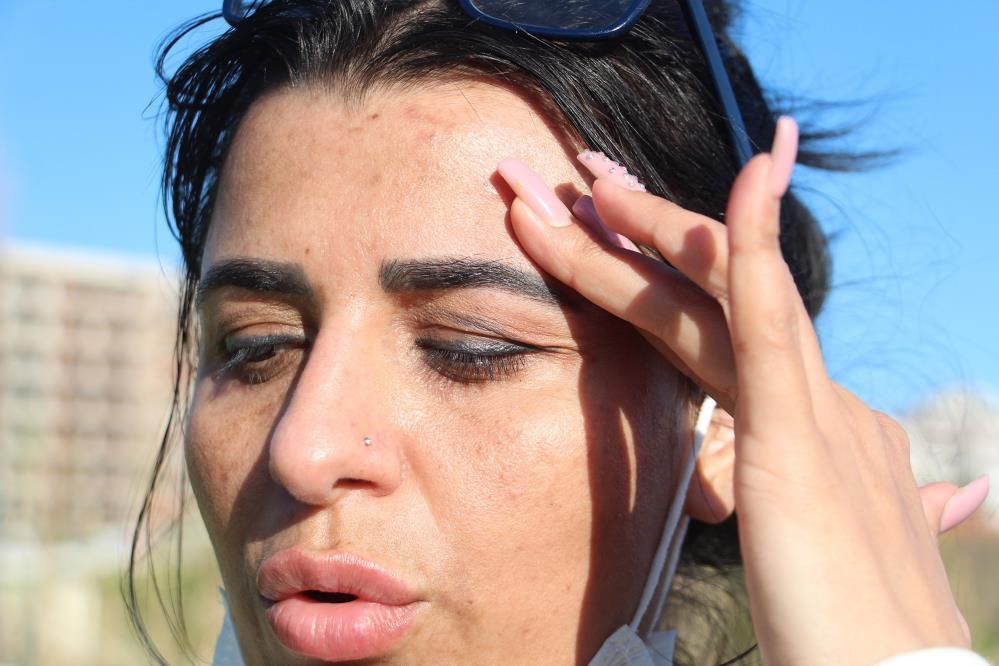 Antalya'da güzellik salonu ilanı hayatının şokunu yaşattı! Yüzünü yaktılar