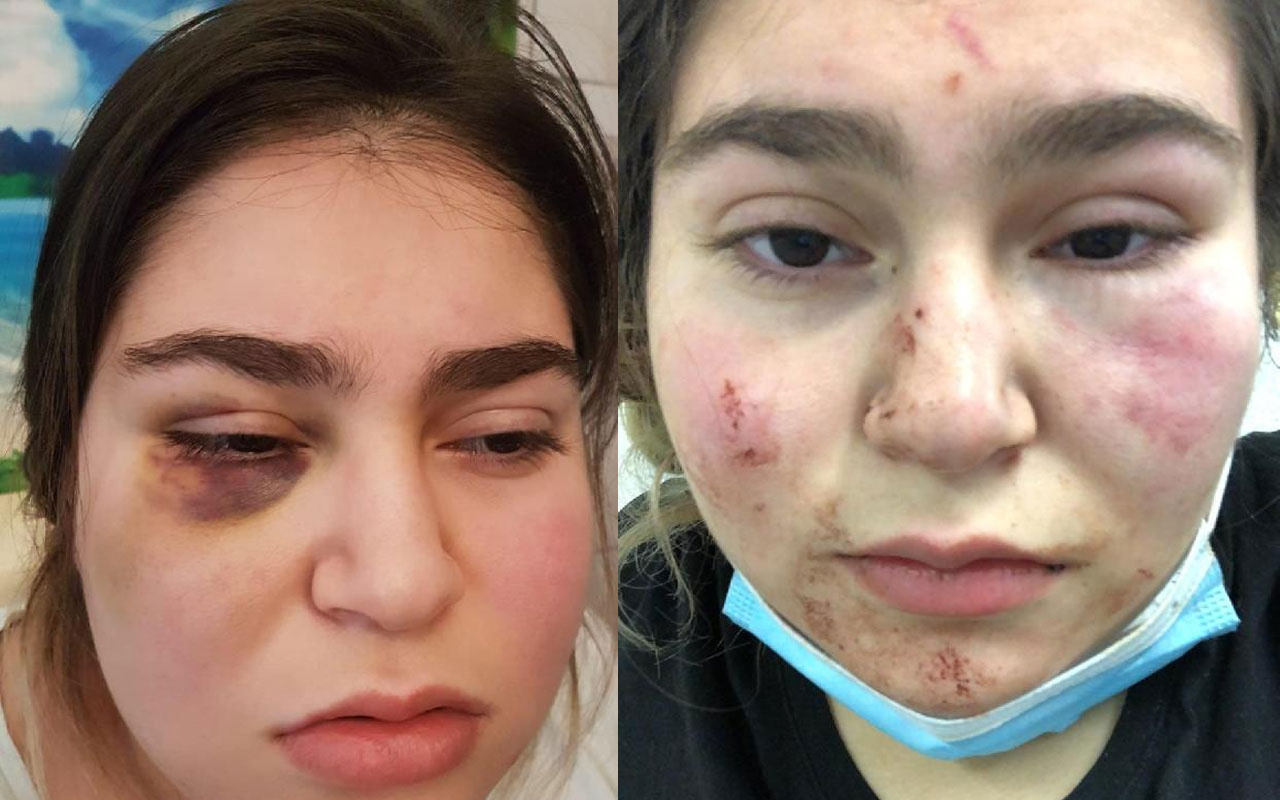 Almanya’da polisin kızıyla birlikte dövdüğü Türk konuştu: Yüzü ve saçları kanlar içindeydi