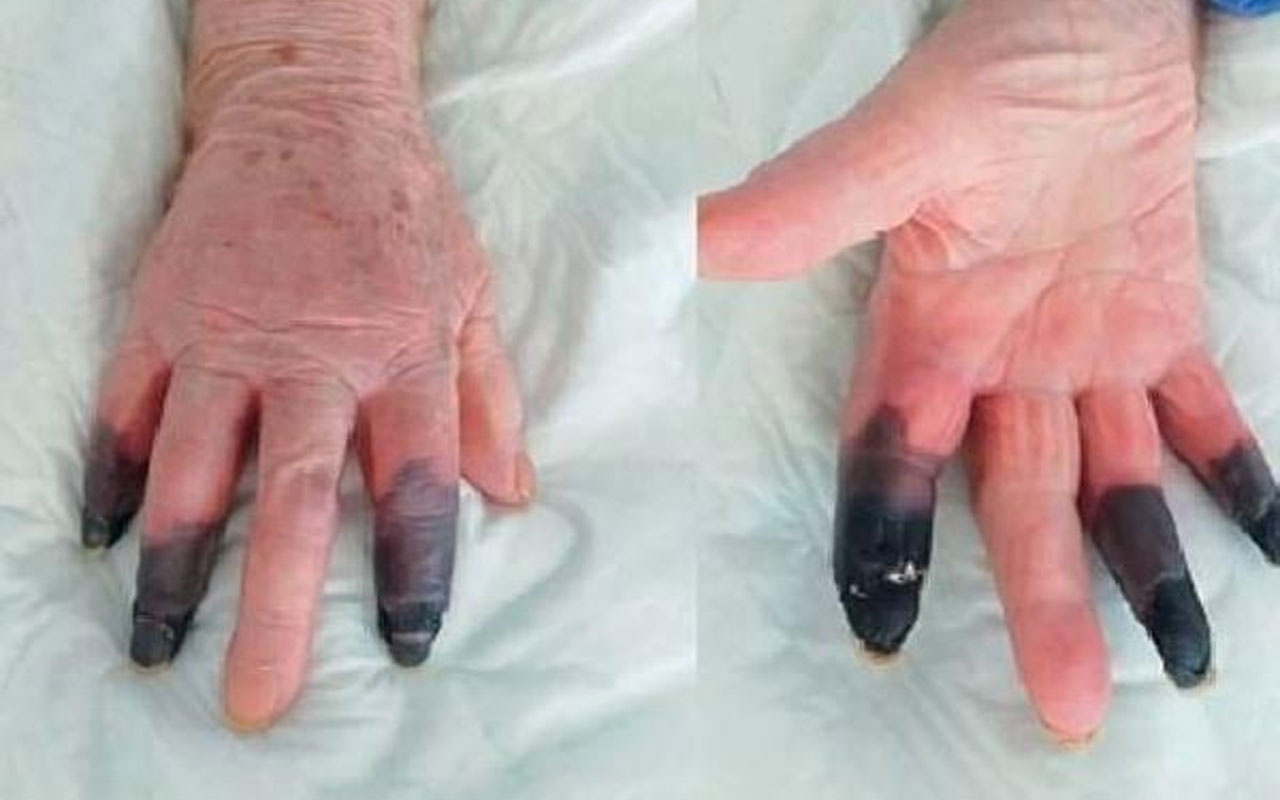 İtalya’da koronavirüs hastası kadın kangren oldu! 3 parmağı kesildi
