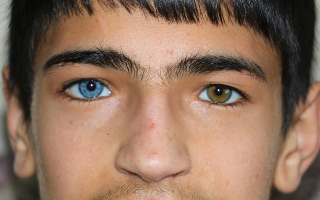 Kahramanmaraş'ta Yasin ve Elif kardeşlerin gözleri ilginç: Hayata çift renk bakıyorlar