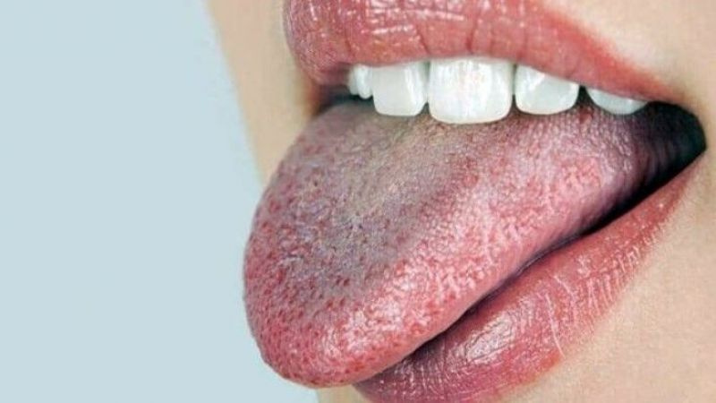 Ağız kuruluğu neden olur ağız kuruluğu nasıl geçer?