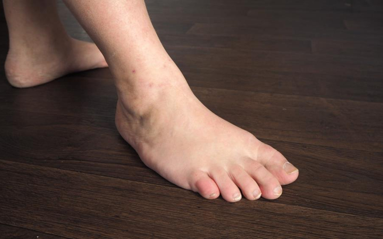 Ayakkabı ayağınıza olmuyorsa dikkat! 5 kişiden 1’inde görülüyor: Kısırlığa neden oluyor