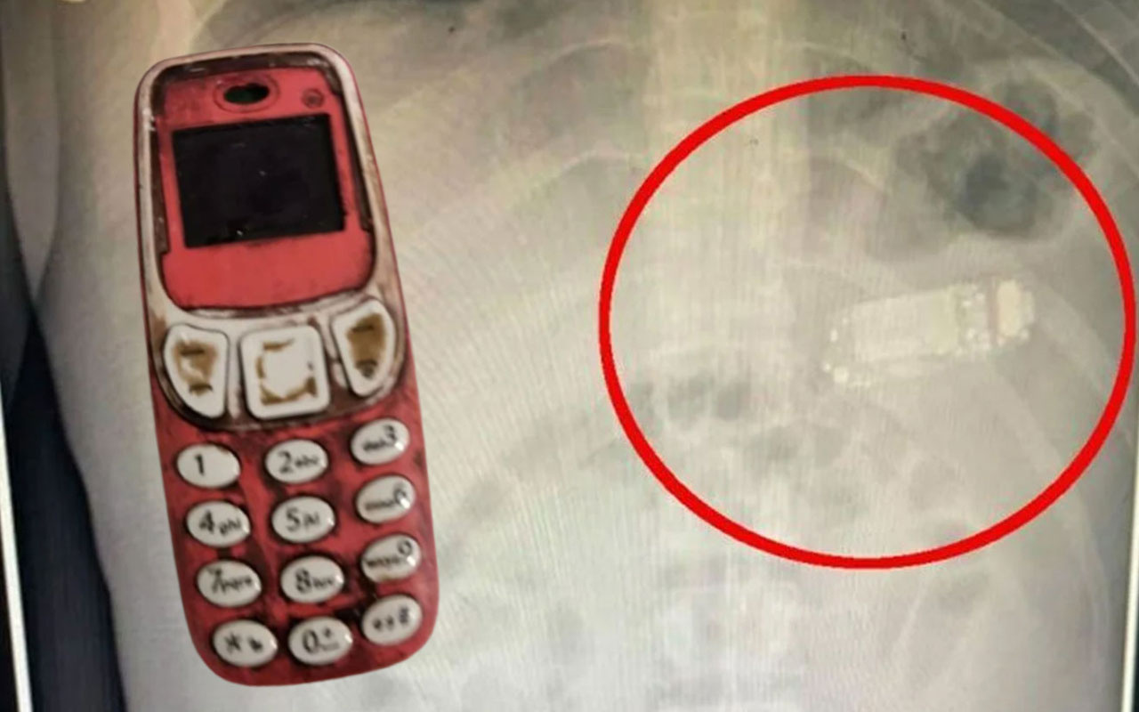 Midesinden Nokia 3310 telefon çıktı! Doktorları şaşırtan ameliyat