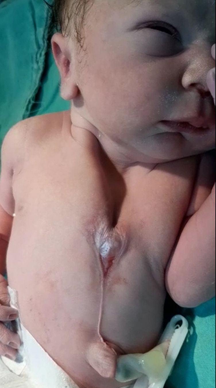 Kalbi dışarıda doğdu! Mucize bebek zor operasyonla kurtarıldı