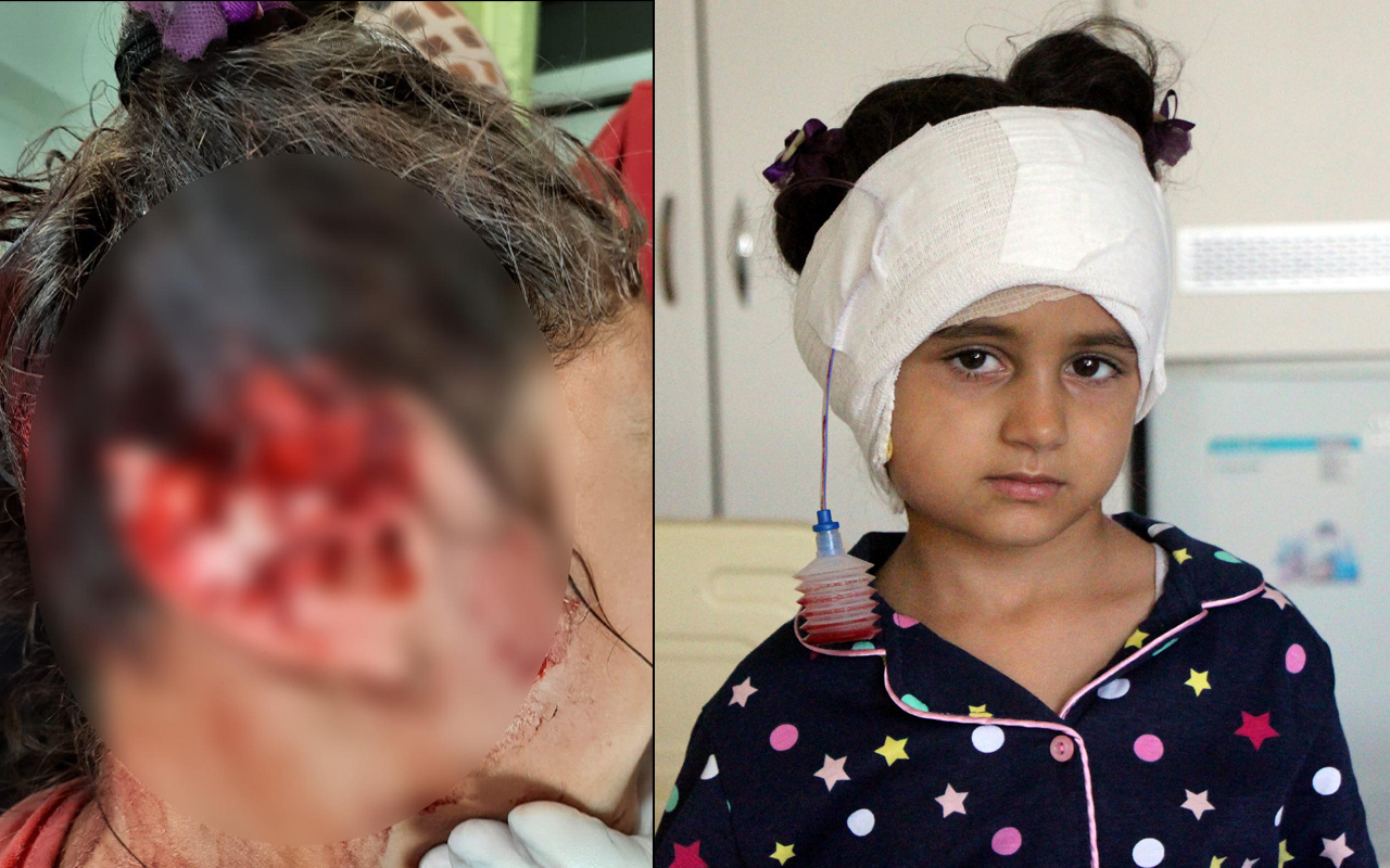 Düzce'de 5 yaşındaki kız kabusu yaşadı! 300 dikiş atıldı: 4 saat 40 yıl gibi geldi
