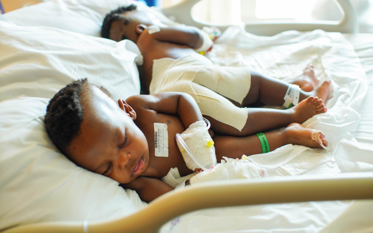 Kamerun'da dünyaya gelen yapışık siyam ikizleri Türkiye'de şifa buldu