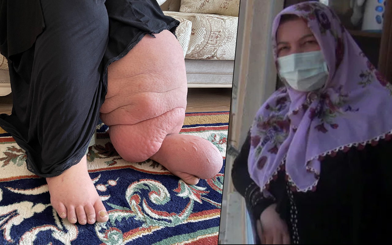 Ayağı 50 kilo oldu! Muş'ta fil hastası kadın en büyük hayaline kavuşacak: 21 yıl...