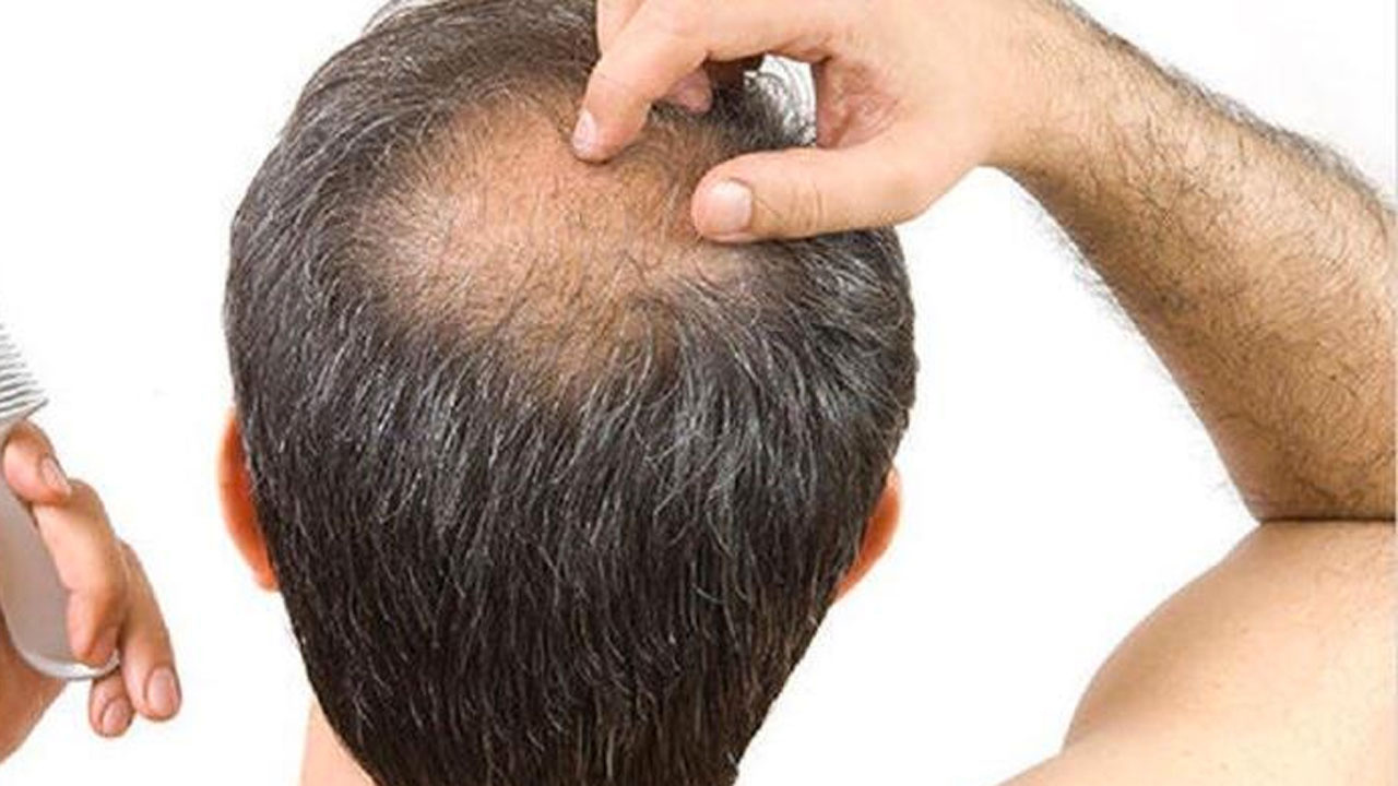 Saç dökülmesi yaşayanlara iyi haber Doç. Dr. Filiz Topaloğlu Demir yöntemi açıkladı