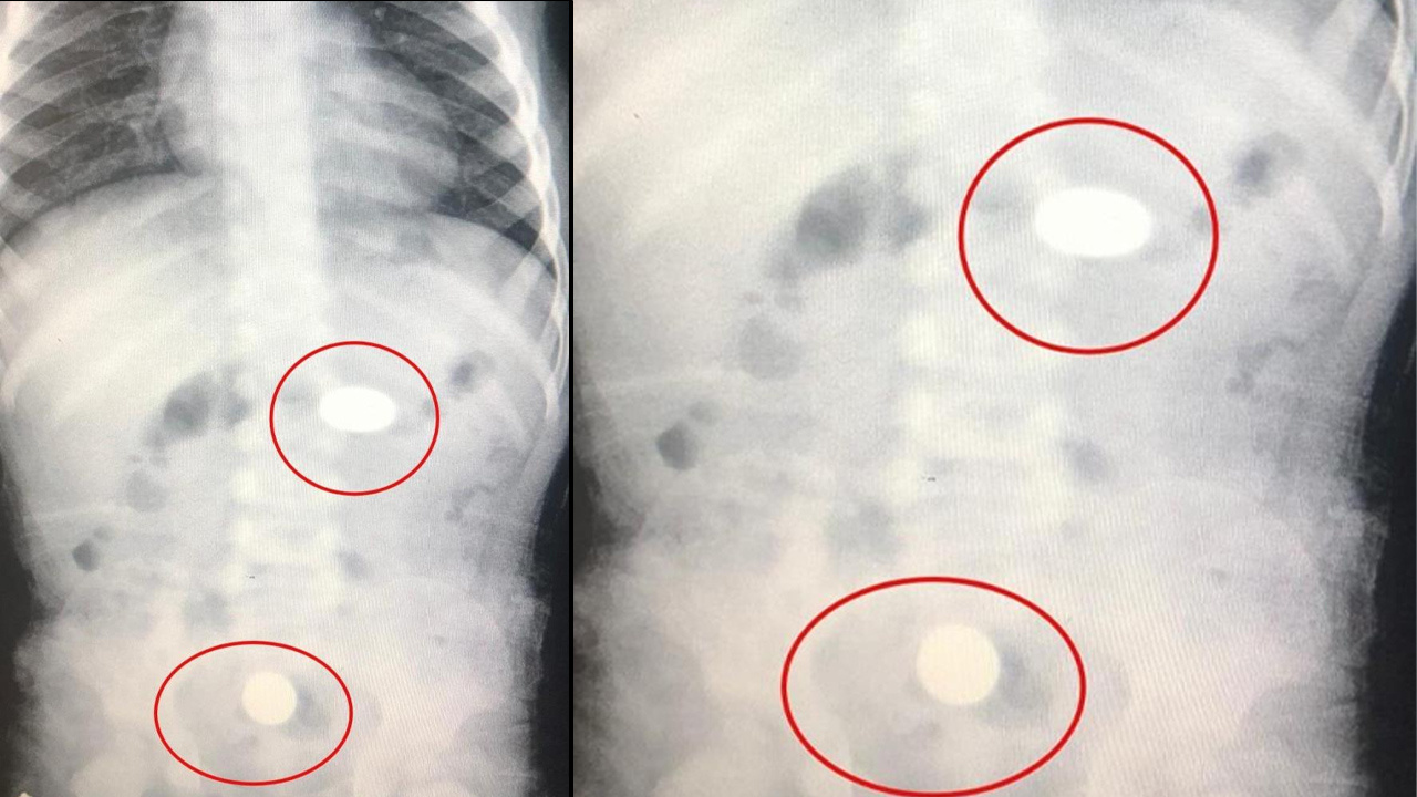 Bursa'da her şey oyun oynarken bir anda oldu! 2 yaşındaki çocuğun midesinden bakın ne çıktı