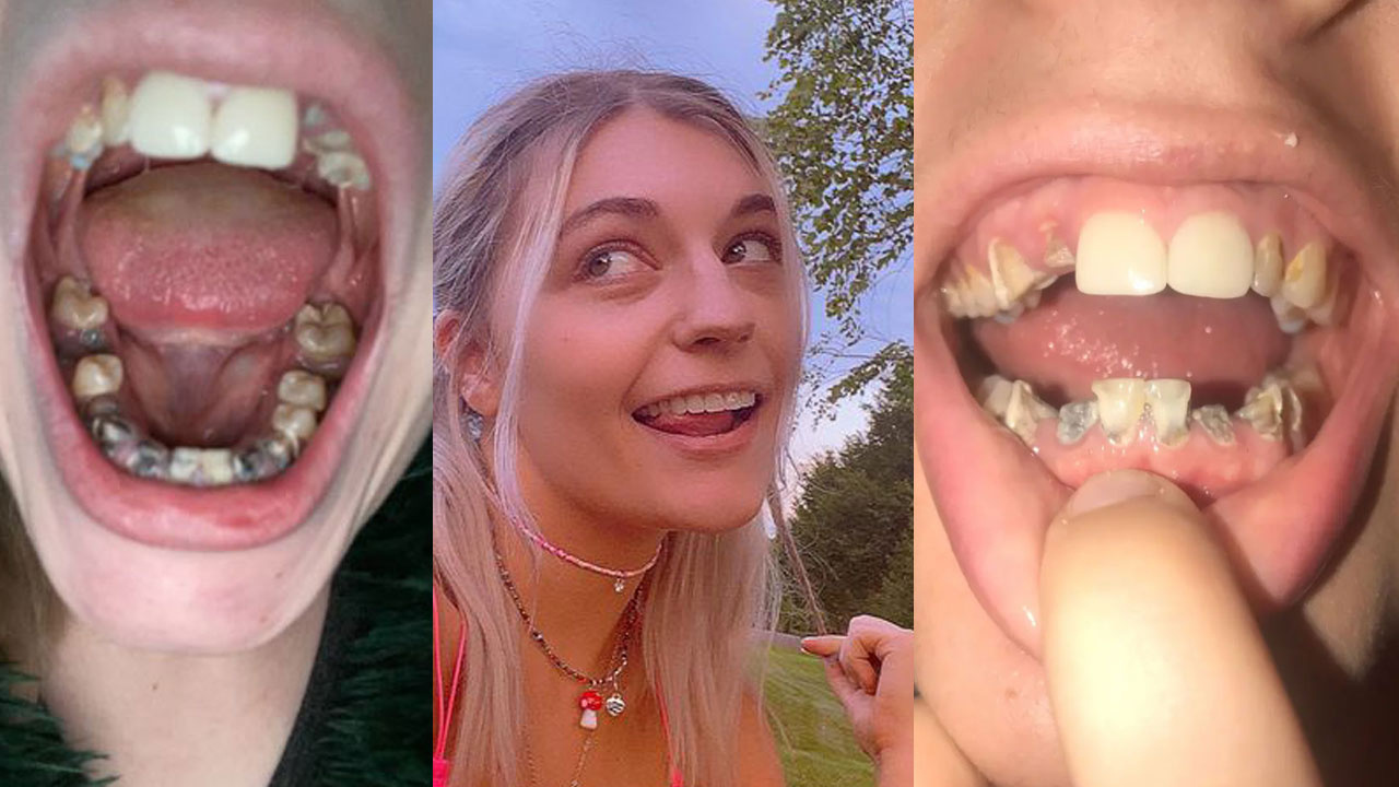 Ağrı kesici bu hale getirdi! 23 yaşındaki kadının tüm dişleri çürüyüp döküldü!