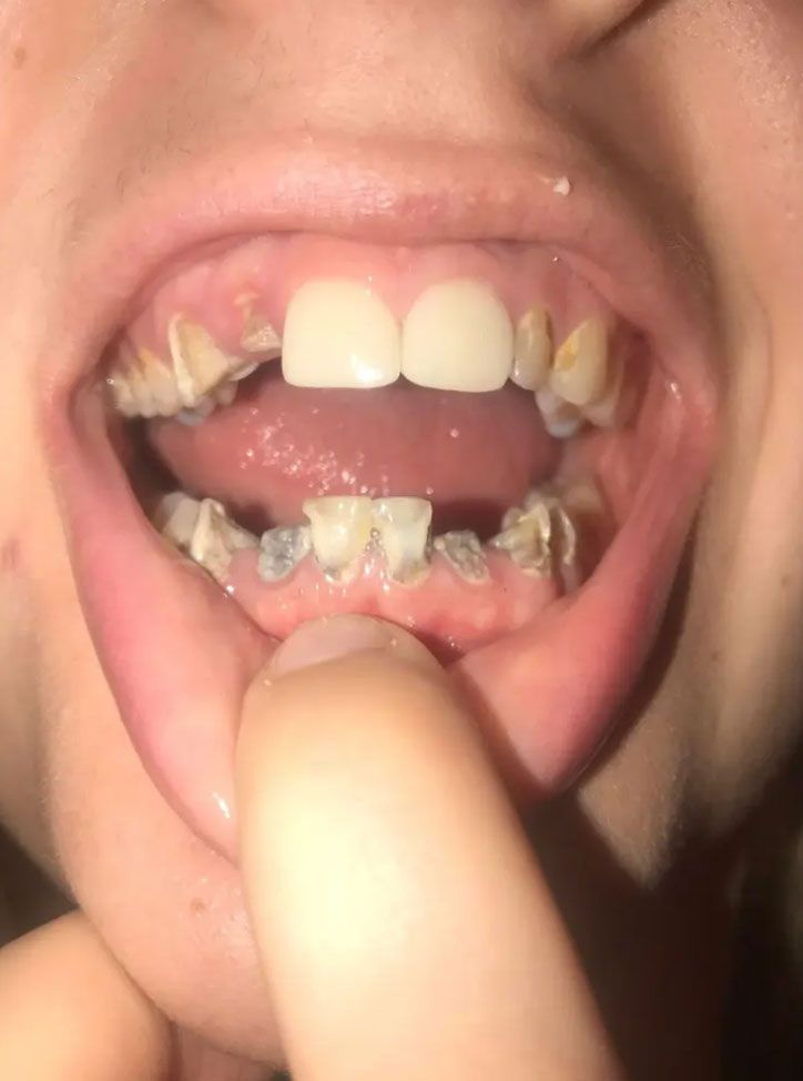 Ağrı kesici bu hale getirdi! 23 yaşındaki kadının tüm dişleri çürüyüp döküldü!