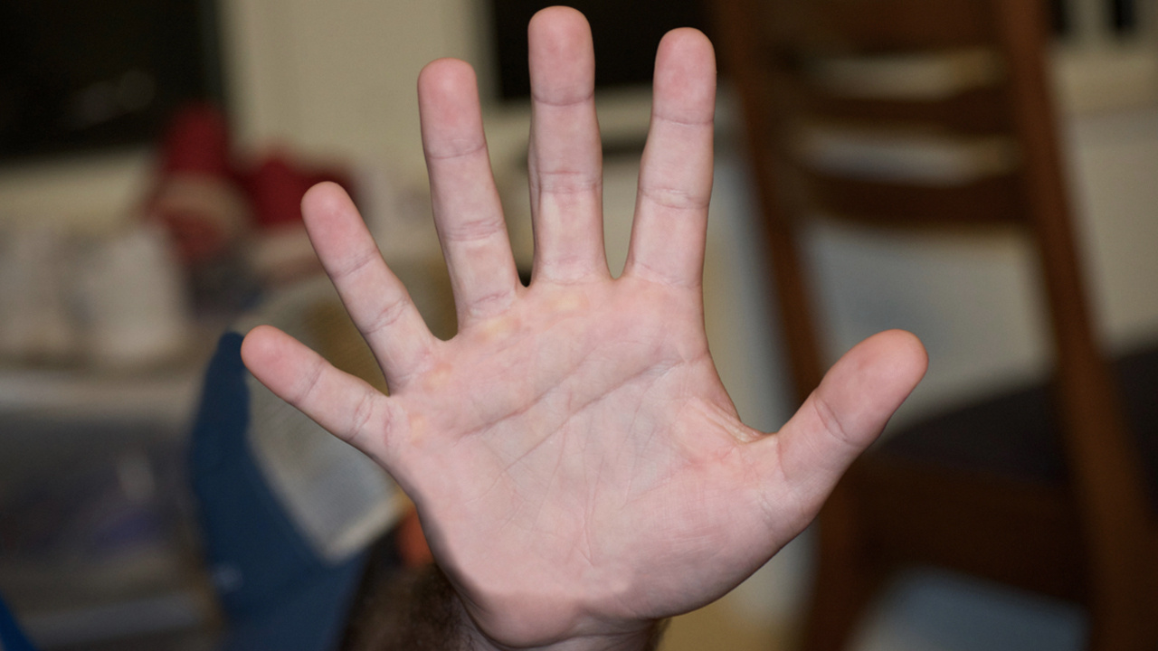İşaret parmağınız yüzük parmağınızdan uzun mu! Kanser olabilirsiniz hemen bu testi yapın