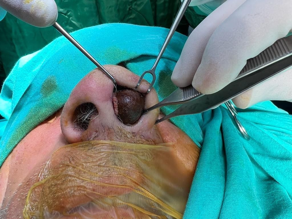 50 yıldır burnunun içindeymiş! 2 saatlik operasyonla çıkarıldı doktor da şoke oldu