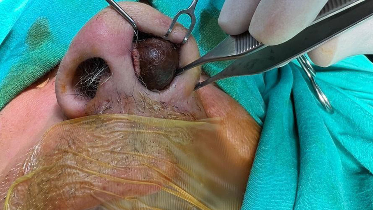 50 yıldır burnunun içindeymiş! 2 saatlik operasyonla çıkarıldı doktor da şoke oldu