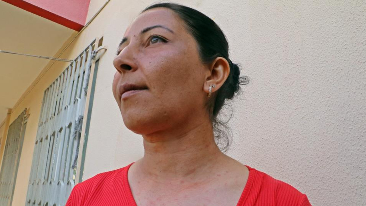 Antalya'da evinin bahçesindeki tırtılları süpüren kadın hastanelik oldu: Yüzüm alev topu gibi oldu