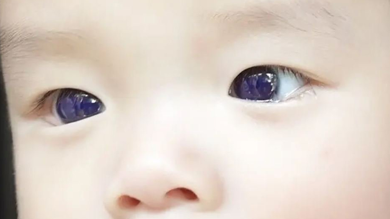 O ilacın etkisi korkuttu! Covid-19 tedavisi olan bebeğin göz rengi değişti