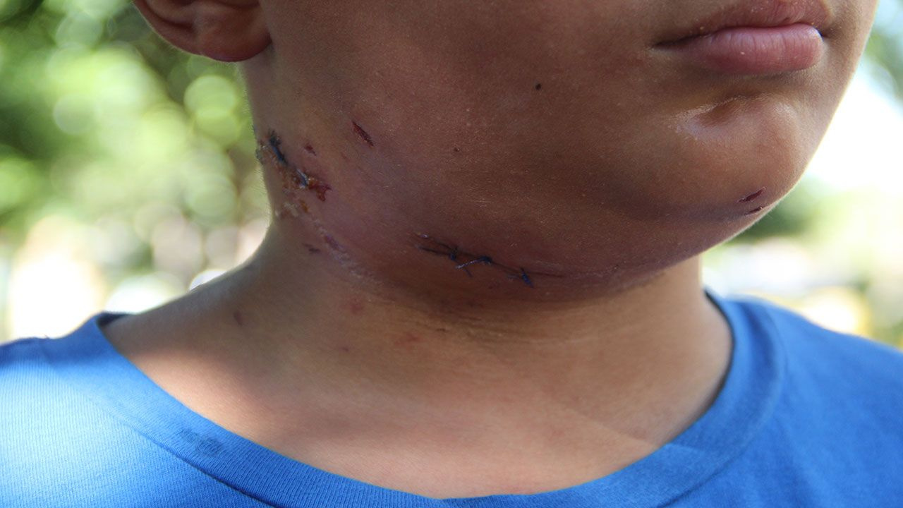 Antalya'da zincirli köpek 10 yaşındaki çocuğun boynuna saldırdı!