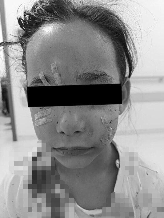 İstanbul'da başıboş köpek dehşeti! 6 yaşındaki kızın yüzünü parçaladı! Küçük kız kuduz mu oldu?