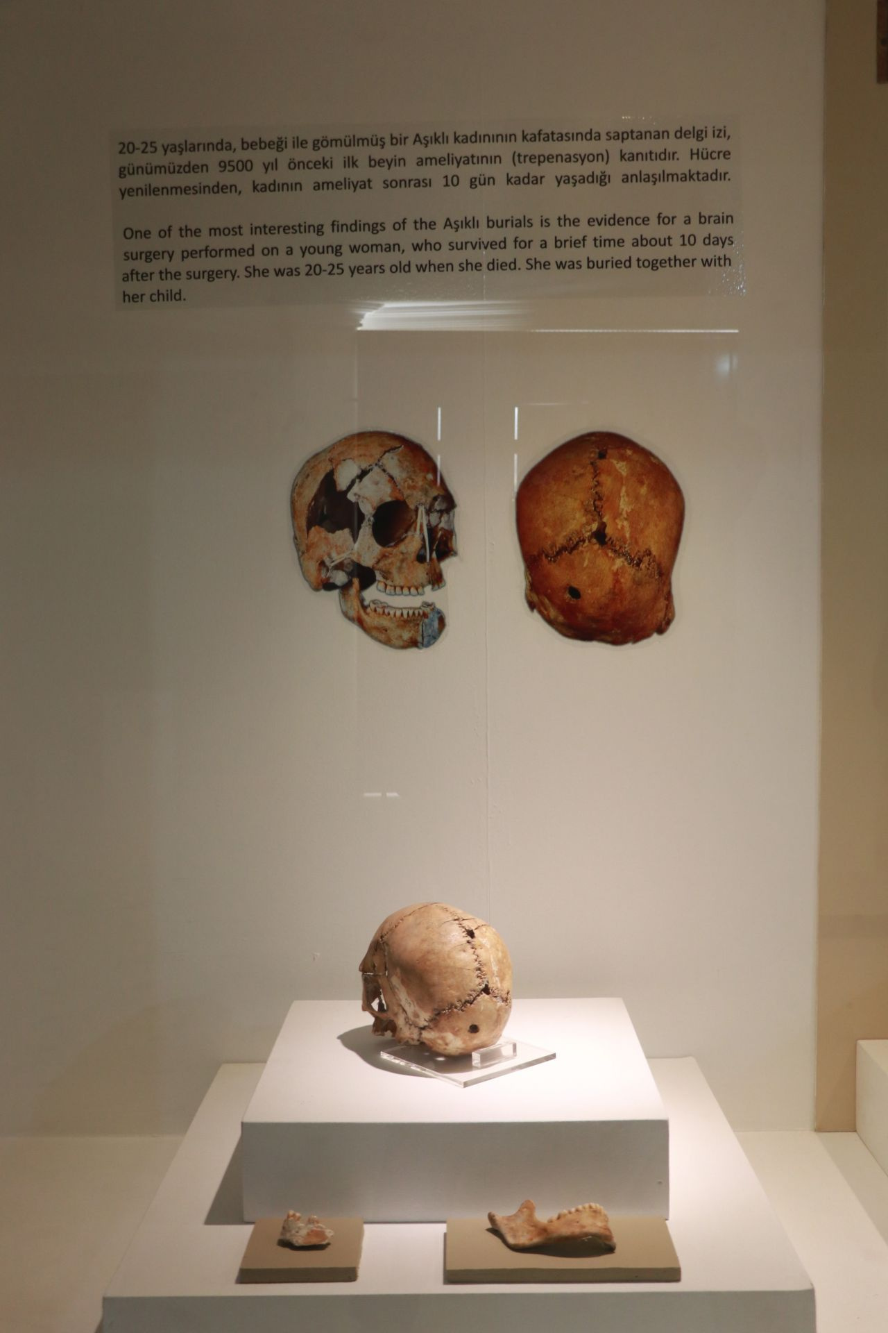 Dünyanın ilk beyin ameliyatına ait kafatası görenleri şaşırtıyor