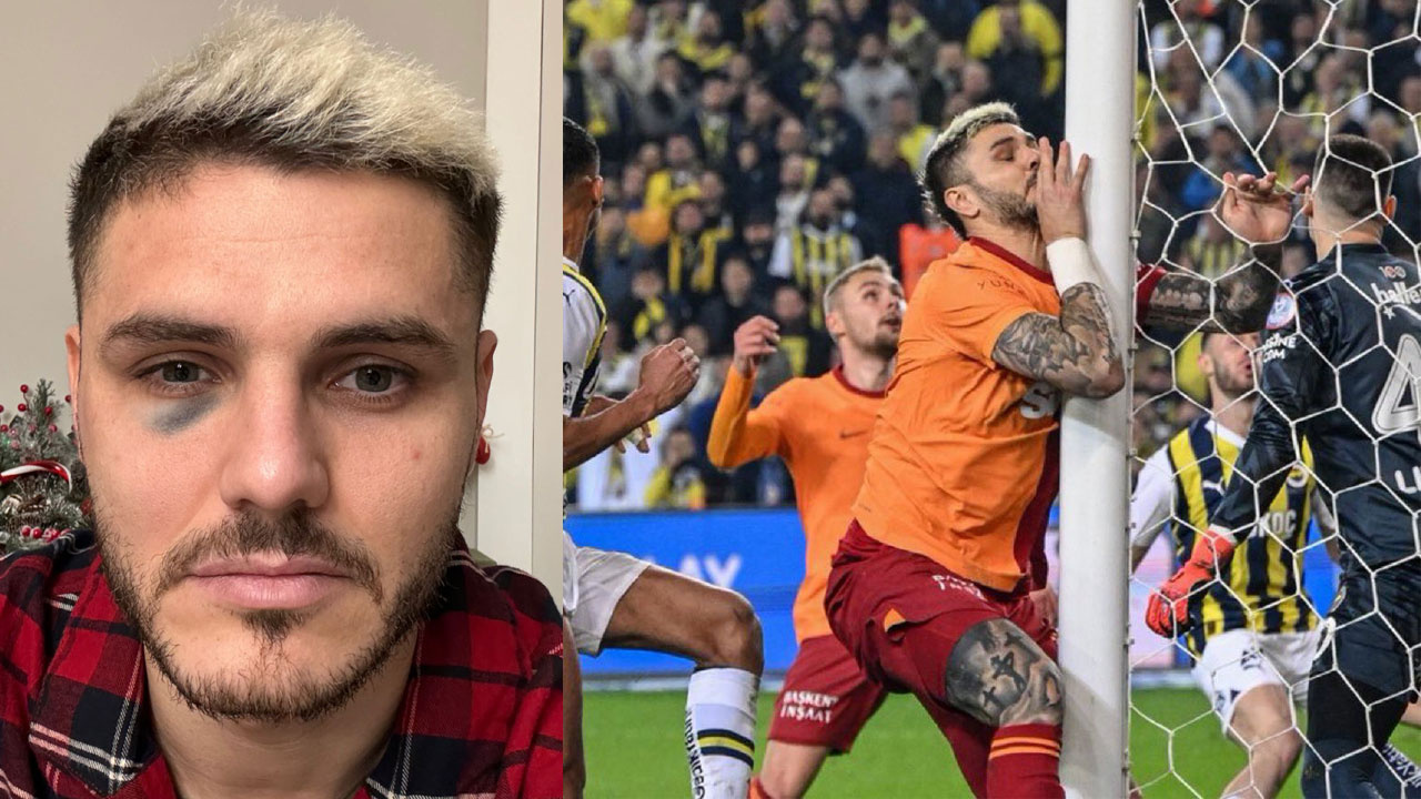 Derbi sonrası Fenerbahçe ile Galasataray Icardi için kapıştı! Dirsek mi morarttı direğe çarptığı için mi morardı