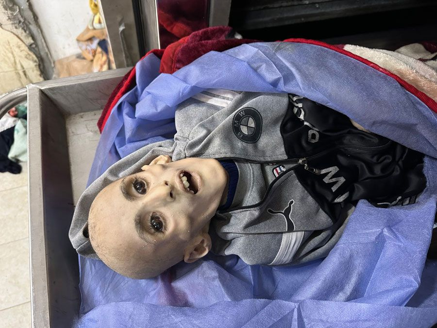 Gazze'de yetersiz beslenme sonucu ölen Filistinli çocuktan geriye bir deri bir kemik fotoğrafları kaldı