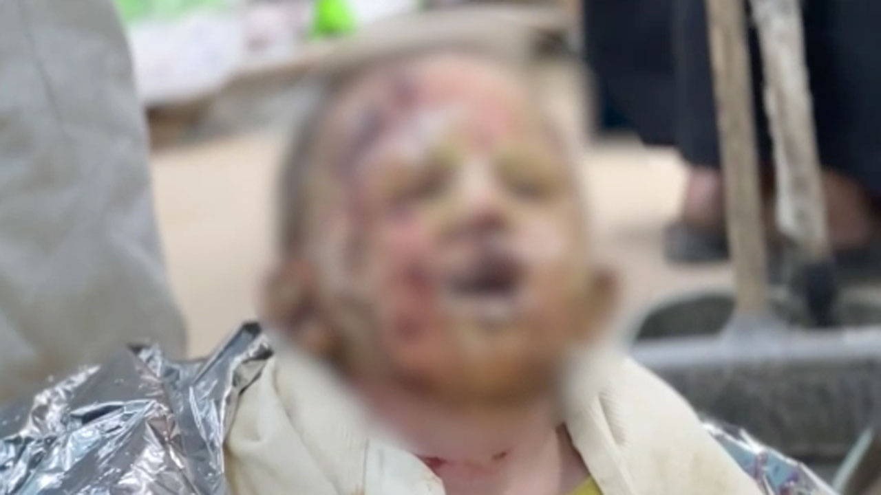 İsrail ordusu, bedeninde derin yanıklar açtığı 4 yaşındaki Seca’yı hastanede de rahat bırakmadı
