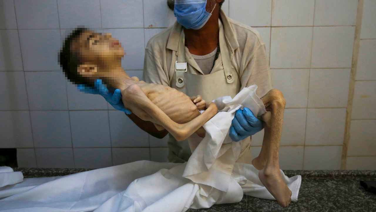 İnsanlıktan utandıran görüntüler! Gazzeli Hikmet, yetersiz beslenme nedeniyle öldü