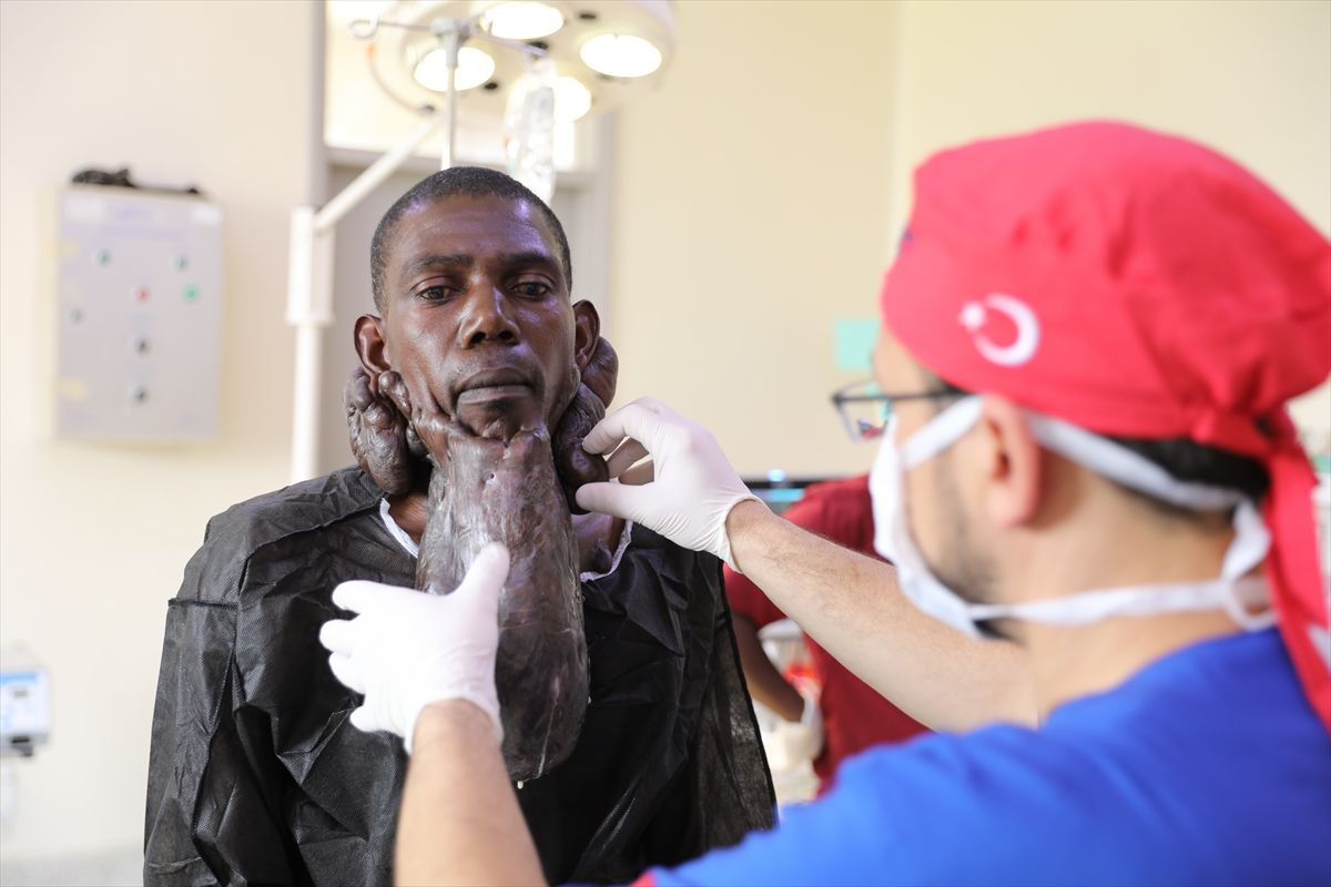 Sakal gibi uzayan 'keloid' şaşkına çevirdi! Ugandalı Muhammed'i Türk doktorlar kurtardı