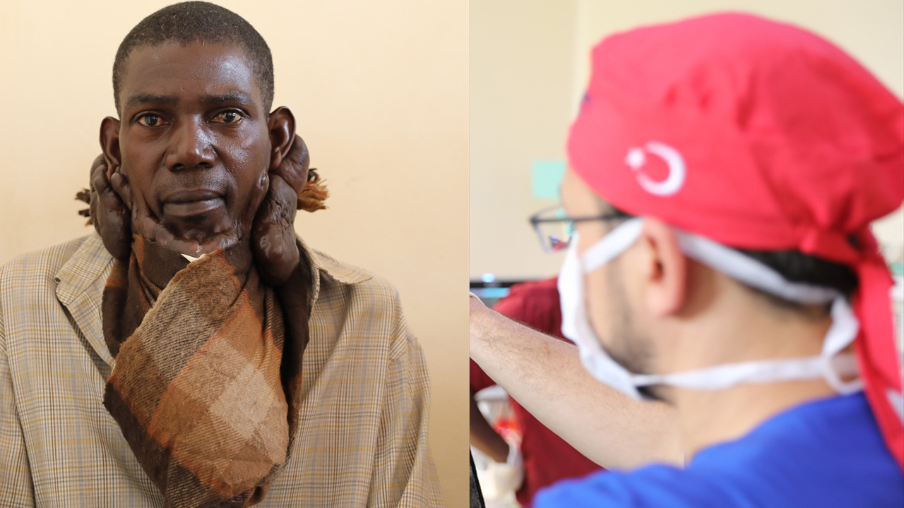 Sakal gibi uzayan 'keloid' şaşkına çevirdi! Ugandalı Muhammed'i Türk doktorlar kurtardı