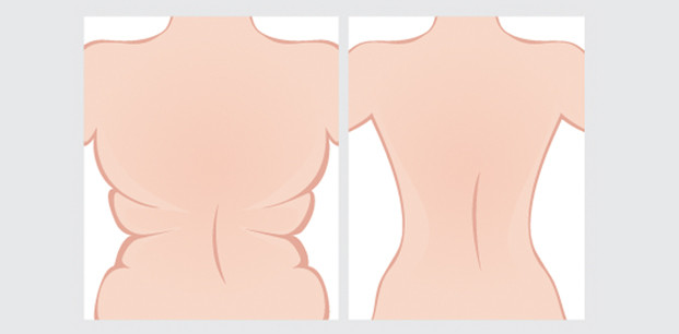 Cushing hastalığı belirtileri